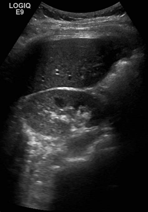 2 while normal range 30-160. . Elevated liver enzymes and negative ultrasound